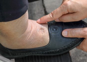 足貼好處原來這麼多！腳腫、腿痠尤其該用