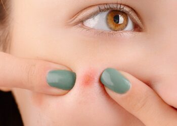 膠原蛋白一天要吃多少才有效？膠原蛋白攝取過量恐導致痘痘大爆發