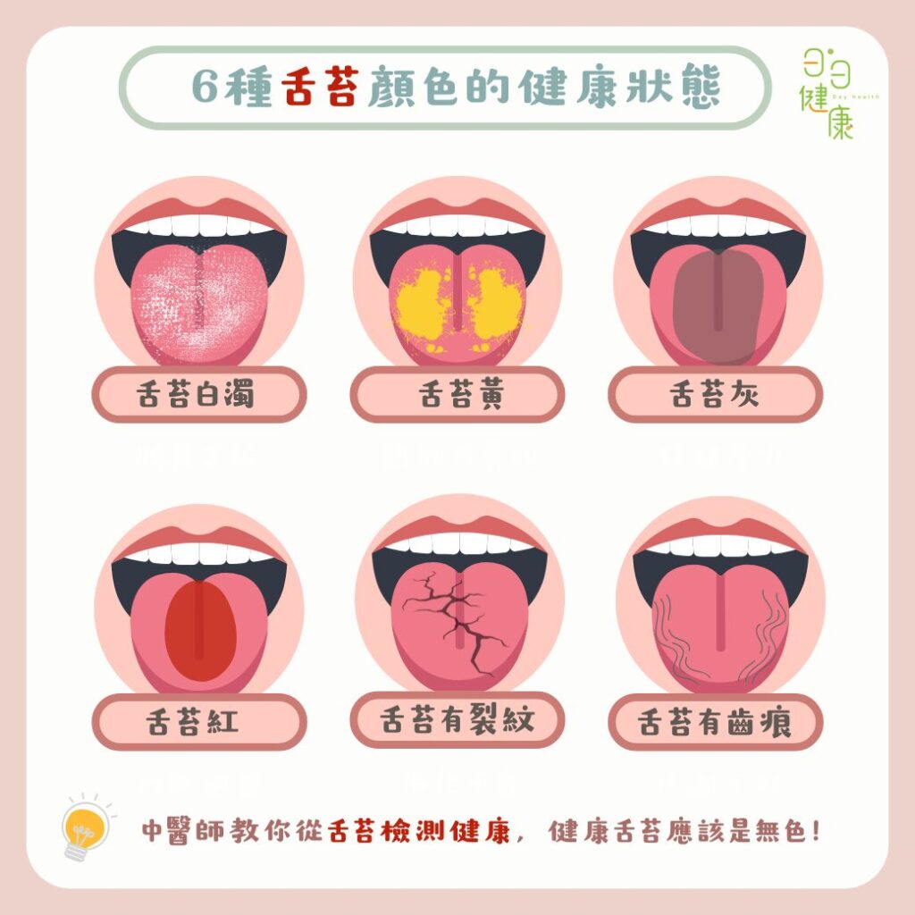從舌苔看身體狀況!舌苔黃色、灰色或有裂痕都要小心 - 日日健康