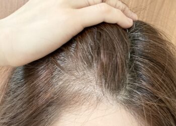 禿頭前兆有哪些症狀？異常落髮、禿頭原因有哪些？5個面向檢測頭髮健康！